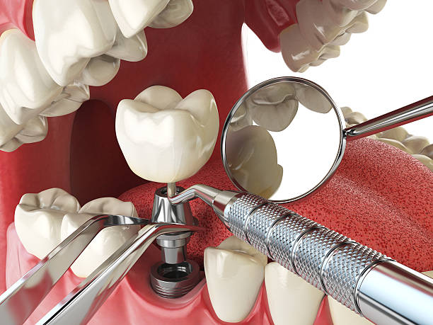 Best Emergency Tooth Extraction in Rathdrum, ID
